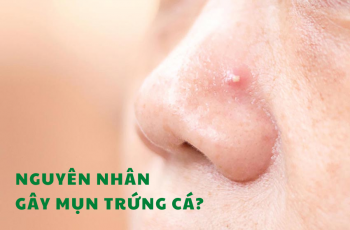 nguyen nhan gay mun trung ca